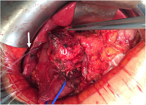 Detalle intraoperatorio (caso 7), en el que se evidencia la cánula de colangiografía (flecha) para localización de la vía biliar distal intrapancreática y la tracción duodenal (vessel-loop azul). U: uncinado.