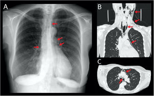 A) Radiografía de tórax: las flechas rojas señalan la presencia de neumomediastino. B y C) Cortes coronal y axial de tomografía computarizada: las flechas rojas señalan la presencia de enfisema subcutáneo cérvico-facial y neumomediastino.