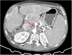 TAC: estenosis en rl tronco celiaco por SLAM (flecha roja).