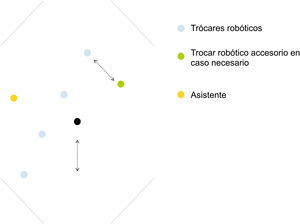 Esquema de distribución de los trocares (general) y minilaparotomia (cuando se reconstruye tránsito digestivo).