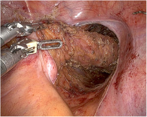 Imagen de TME en tumor sincrónico de recto y vejiga. Nótese que en este caso el plano anterior se ha disecado.