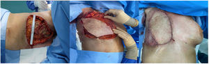 Defecto de pared torácica anterior de 22×16cm tras desbridamiento radical con estructuras de pared costal desvitalizadas; reconstrucción de pared torácica anterior con colgajo miocutáneo de dorsal ancho tunelizado a nivel axilar e injerto de piel parcial.