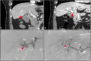 Ilustración 1. A) Colecistitis aguda sobre colecistopatía crónica asociada a fístula colecistocólica. B) Hemorragia activa intravesicular C) PAAHD. D) Arteriografía postembolización con coils. VB: vesícula biliar; FCC: fístula colecistocólica; AHI: AH izquierda; AHP: AH propia; AC: A cística; AHC: AH común; AGD: A gastroduodenal.