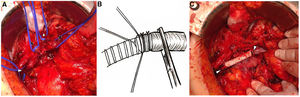 A)Imagen intraoperatoria tras resección del tumor. Se aprecia imposibilidad de reconstrucción mediante anastomosis término-terminal. Punta de flecha blanca: extremo portal; flecha negra: vena mesentérica inferior; flecha blanca: vena esplénica; punta de flecha negra: extremo de vena mesentérica superior. B)Ilustración representativa de la canulación de la prótesis de PTFE en el interior de la vena porta con posterior fijación mediante ligaduras de seda. C)Resultado final tras canulación de la prótesis de PTFE en el interior de la vena porta. Las puntas de flecha señalan las ligaduras de seda.