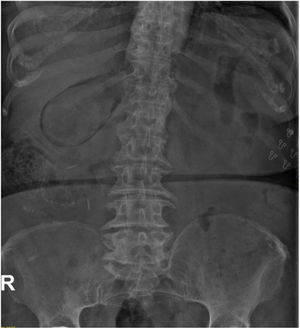 Radiografía de abdomen.