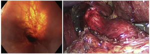 A)Visión endoscópica en la que se visualiza la mucosa y la transparencia de la miotomía. B)Visión laparoscópica que permite visualizar la extensión y la calidad de la miotomía.