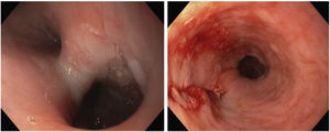 A)Visión endoscópica que visualiza la luz esofágica y la cavidad diverticular. B)Visión endoscópica que visualiza la mucosa esofágica y la línea de sección del cuello del divertículo.