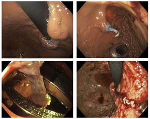 A)Visión endoscópica de tumoración submucosa próxima a la unión esofagogástrica. B)Visión endoscópica de gastrostomía y colocación transgástrica de los trócares de laparoscopia. C)Visión endoscópica de la sección realizada con endograpadora. D)Visualización endoscópica de la línea de sección.