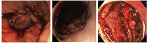A)Visión endoscópica de anastomosis gastroyeyunal mecánica laterolateral. B)Visión endoscópica de anastomosis esofagoyeyunal terminolateral mecánica con CEEA de 25mm. C)Visualización endoscópica de anastomosis esofagogástrica terminolateral mecánica con CEEA de 25mm (a nivel cervical).
