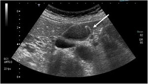 Imagen ecográfica de adenomiomatosis vesicular con artefacto en «cola de cometa» (flecha).