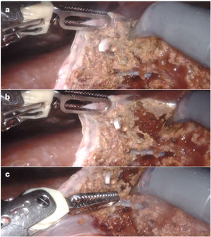 Transección parénquima hepático mediante «microfractura-coagulación» por vía robótica. Leyenda: Transección parénquima hepático mediante «microfractura-coagulación» por vía robótica mediante la aplicación combinada de energía monopolar y bipolar. a) Posición inicial de las herramientas pinza bipolar y tijera monopolar. b) Acción de microfractura sobre la superficie parenquimatosa para profundizar en la transección. c) Acción de coagulación selectiva tras la profundización.