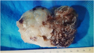 Macroscopic image of a polypoid tumor measuring 7.5 × 5 × 3.5 cm, with a solid, nodular, yellowish-white surface with areas of hemorrhage.
