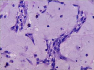 H&E, 40×. Groups of neoplastic cells with polyhedral and stellate cell borders with monotonous thin chromatin nuclei and discrete nucleolus in a myxoid matrix.