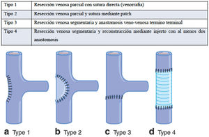 Clasificación del International Study Group on Pancreatic Surgery para la resección venosa y su reconstrucción.