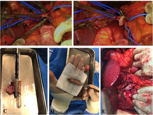 A: Imagen intraoperatoria. Vena porta seccionada en su porción lateral. B: Imagen intraoperatoria. Reconstrucción mediante patch de falciforme. C: Reconstrucción tipo 4. Confección mediante injerto autógeno de peritoneo mediante endograpadora lineal con carga vascular. D: Visión final de injerto autógeno confeccionado con peritoneo y vaina posterior del músculo recto anterior del abdomen. E: Imagen final de reconstrucción vascular tipo 4 con injerto autógeno mediante 2 suturas continuas semicirculares de prolene 4/0 y growth factor a la pared del vaso.