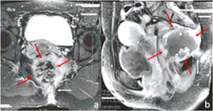 (a: coronal view, b: sagittal view) Solid and cystic mass in presacral retro-rectal space (red arrows) with fistulous tract opened in sacro-coccygeal fold (white arrows).