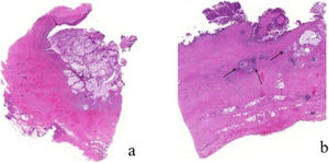 (a) Haematoxylin–Eosin 40×, showing neoplastic degeneration of the cyst wall with intestinal epithelium. Note pools of extracellular mucin; (b) atypical glands with abundant extracellular mucin; low power view of the cyst wall with a smooth-muscle coat in two layers. The inner lining mucosa shows intestinal type epithelium with high-grade dysplasia and invasive adenocarcinoma (arrows).