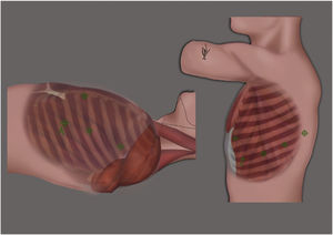 Left: Port placement for RATS thymectomy. 4 ports were used. One port was inserted in the third intercostal space and two in the fifth intercostal space. The assistance was placed at the level of the sixth intercostal space. Right: Port placement for RATS lung resection. All ports including assistance (A) were placed in the eighth intercostal space, except for the anterior port, which was placed in sixth intercostal space.