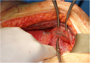 Dissection of the space between previous absorbable and permanent meshes in a patient reoperated for hernia recurrence using a combination of meshes during the index procedure.