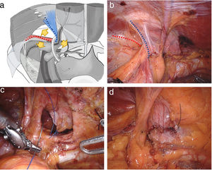 Preparation on the myopectineal orifice. (a and b) The start of the procedure fis at Hesselbach's ligament, from where all structures of the myopectineal orifice are developed (Hesselbach's ligament=blue dashed line; ileopubic tract=red dashed line); the yellow arrows show the 3 pathways for dissection; (c and d) Example of morphological reconstruction of the posterior wall of the inguinal canal in a medial hernia.