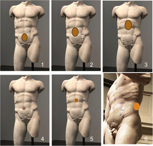 Possible eTEP port setups. 1 – the upper approach is the most often used laparoscopically for midabdominal, inferior, and some lateral hernias. 2 – the lateral approach is favored by robotic surgeons for most hernias. 3 – the lower approach is used for subxiphoid and other upper hernias. It is the least resorted to of the three. 4 – the precostal approach is favored by our group for almost all ventral hernia repairs. 5 – Mnouskin eTEP limited approach for umbilical hernias that require mesh with or without associated inguinal hernias and, 6 – directly-lateral-to-the-semilunar-line approach for lumbar (L4) hernias.