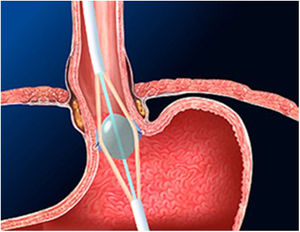 Stretta. Se observa el inflado del balón y la emisión de radiofrecuencia. Fuente: Radiofrequency treatment for gastroesophageal reflux disease. George Triadafilopoulos M. UpToDate.