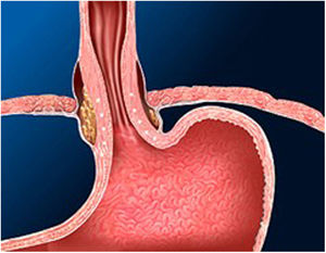 Stretta. UEG a los 6 meses: se observa engrosamiento de las fibras de colágeno. Fuente: Radiofrequency treatment for gastroesophageal reflux disease. George Triadafilopoulos M. UpToDate.