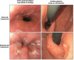 Stretta. UEG antes y después del tratamiento. Fuente: Radiofrequency treatment for gastroesophageal reflux disease. George Triadafilopoulos M. UpToDate.