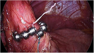 LINX. Anillo de imanes colocados alrededor del esfínter esofágico superior (EES). Fuente: Magnetic sphincter augmentation (MSA). Brian E Louie UpToDate.