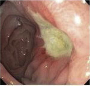 Úlcera marginal diagnosticada endoscópicamente.