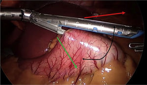Colocación de endograpadora siguiendo flecha inferior para intentar aumentar la longitud del pouch.