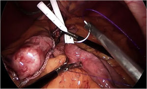 Sutura entre yeyuno y pouch para evitar parte del reflujo biliar.