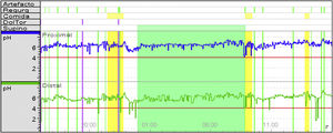 Paciente con obesidad, con un IMC de 42 y con episodios de regurgitación. Gráfico de pHmetría de 24h, con sensor de pH esofágico proximal y distal, observando reflujo fisiológico, episodios de reflujo de corta duración durante el día, con aclaramiento adecuado.
