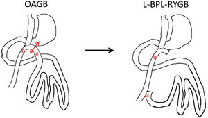 Conversión de OAGB a RYGB con asa biliopancreática larga.