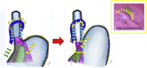 Secuencia de la deglución y válvula antirreflujo. Vista desde gastrostomía (flap valve).