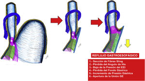 Pérdida del mecanismo valvular como consecuencia de la resección propia de la gastrectomía vertical.