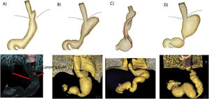 Ilustración y reconstrucción 3D de complicaciones relacionadas con la aparición de enfermedad por reflujo gastroesofágico en la gastrectomía vertical. A)Deslizamiento intratorácico. B)Dilatación del fondo gástrico y del esófago. C)Torsión. D)Estenosis/estrechamiento de la incisura angularis. En todos los casos se ve deslizamiento de la manga.
