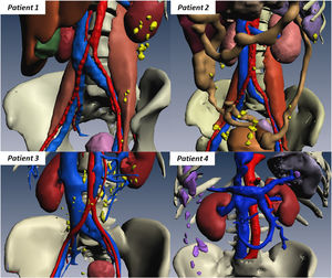 Three-dimensional reconstructions based on the preoperative CT images showing peritoneal implants (yellow in patients 1-3, purple in patient 4).