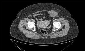 TAC abdominal con contraste.