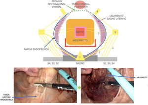 Plano de disección laparoscópica posterior de la escisión casi total del mesorrecto (línea roja) en el abordaje del near-TME. Acceso al espacio presacro posterior a la fascia mesorrectal.