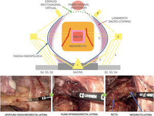 Plano de disección laparoscópica lateral de la escisión casi total del mesorrecto (línea roja) en el abordaje del near-TME.