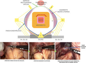 Plano de disección laparoscópica anterior de la escisión casi total del mesorrecto (línea roja) en el abordaje del near-TME.