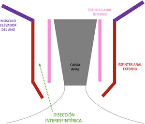 Dibujo esquemático de la disección interesfintérica del abordaje perineal del near-TME.