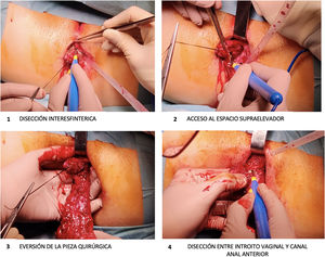 Abordaje perineal de proctectomía.