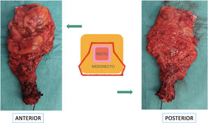 Pieza quirúrgica de proctectomía en una paciente con CU.CU: colitis ulcerosa.