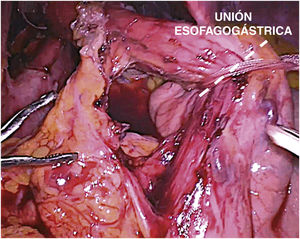Disección extensa de la UEG. UEG: unión esofagogástrica.
