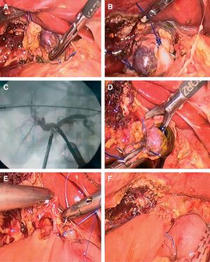 Reparación temprana de LQVB, HYA terminolateral: (A) colédoco ligado y seccionado en su porción distal. (B) Extremo distal de la vía biliar principal ligada y seccionada. (C) Colangiografía intraoperatoria con pinza de Olsen donde se evidencia indemnidad de la vía biliar intrahepática. (D) Sección y avivamiento del borde proximal del colédoco para garantizar una correcta irrigación del borde biliar de la anastomosis. (E) Sutura surgete posterior con monofilamento irreabsorbible 6-0. (F) Anastomosis finalizada. HYA: hepaticoyeyunoanastomosis; LQVB: lesiones quirúrgicas de la vía biliar.