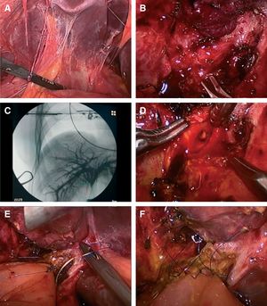 Reparación tardía de LQVB, HYA laterolateral según técnica Hepp-Couinaud: (A) adherencias en relación con antecedentes quirúrgicos. (B) Disección de placa hiliar con maniobras romas y tijeras. (C) Colangiografía intraoperatoria por punción con aguja 30G donde se evidencia indemnidad de la vía biliar intrahepática. (D) Apertura de cara anterior del conducto hepático común con extensión a la izquierda según técnica de Hepp-Couinaud. (E) Sutura surgete posterior finalizado con monofilamento irreabsorbible 5-0. (F) Anastomosis finalizada con puntos separados en cara anterior. HYA: hepaticoyeyunoanastomosis; LQVB: lesiones quirúrgicas de la vía biliar.