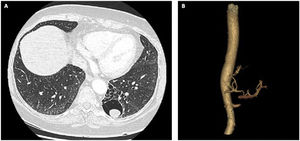 Chest computed tomography showing a cystic lesion with a 2.2-cm nodular content at the base of the left lower lobe (A). Three-dimensional reconstruction demonstrates systemic blood supply from the splenic artery (B).