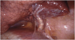 Intraoperative view of the systemic arterial branch to the sequestration originating below the diaphragm.